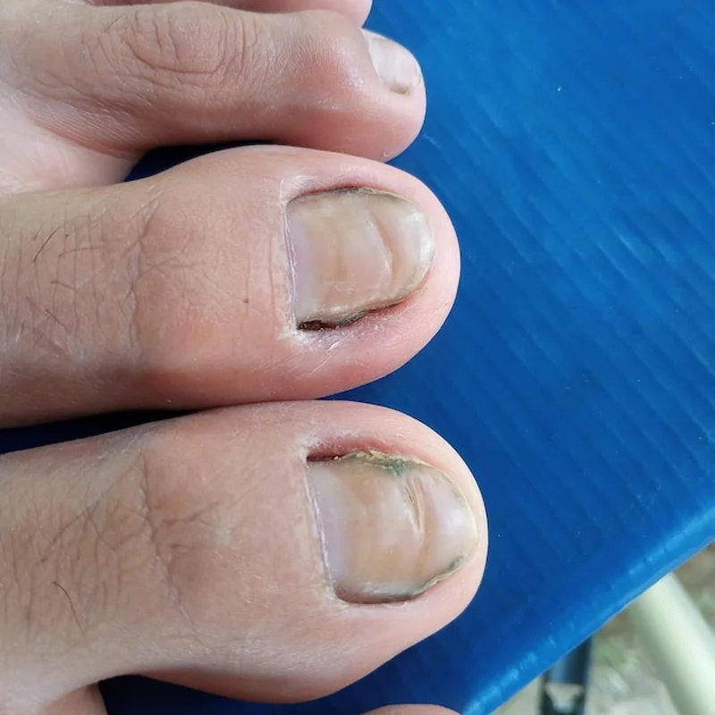 Jak pozbyć się kurzajki na stopie? Skuteczne domowe sposoby